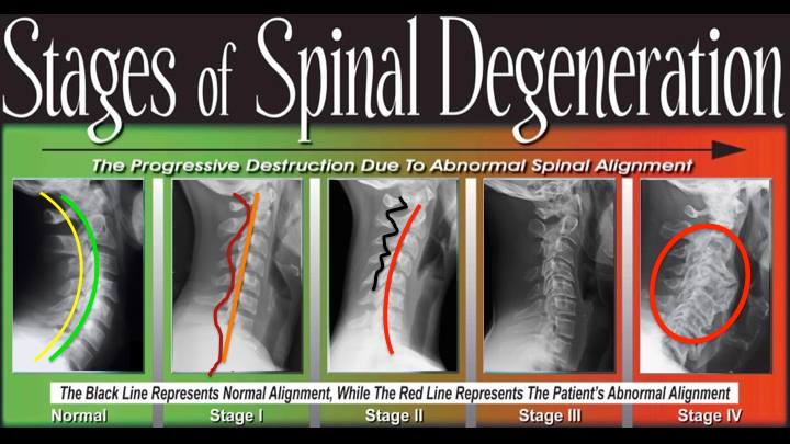 Why Your Spine Goes Out of Alignment? • Collins Chiropractic